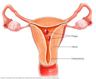 Endomerrial Polyp
